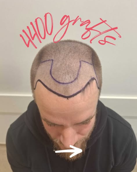 Hair Replacement Surgery UK - Trusted Clinic in London, Leeds & Manchester