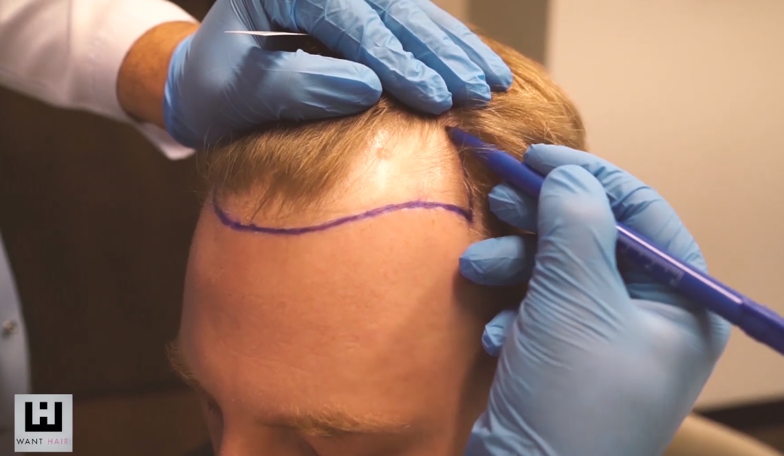 Best Hair Transplant Turkey - Affordable &amp; Natural Results