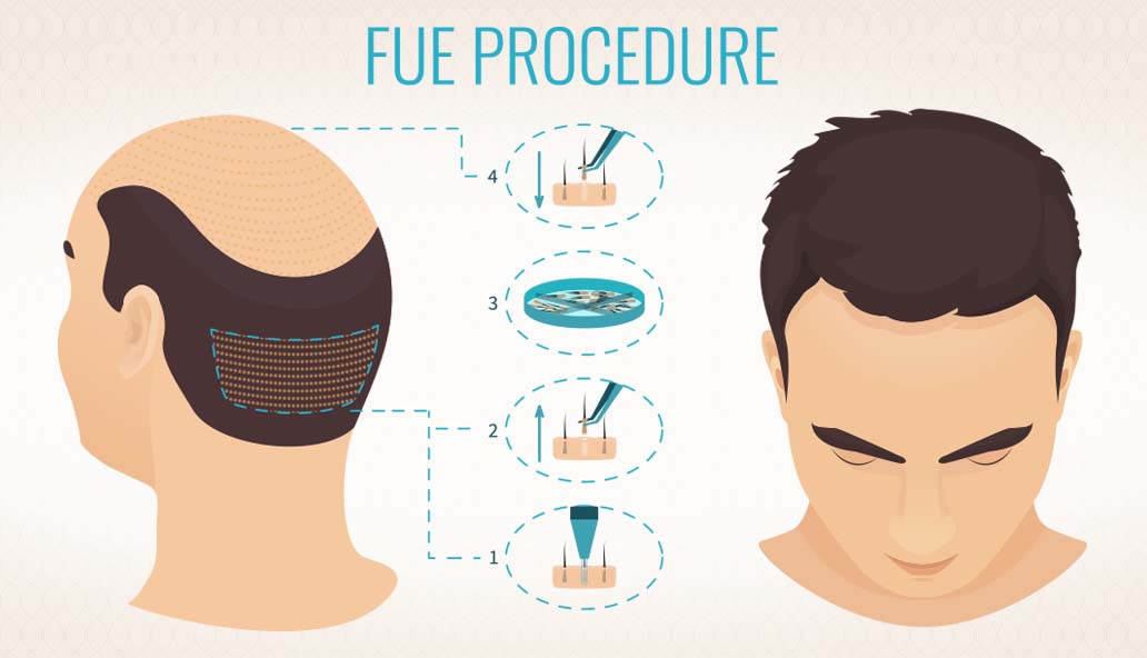 Want Hair Ltd - Trusted FUE Hair Transplant Clinic in Manchester