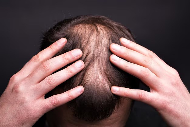 Say Goodbye to Hair Loss - Try Alopecia Treatment UK